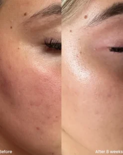 clay and glow niacinamide serum 10% Niacinamide treatment serum