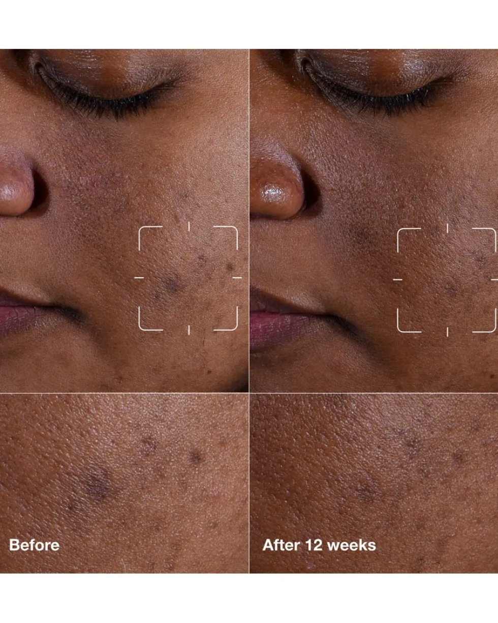 clinique even better clinical™ dark spot clearing serum Serum