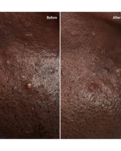 the inkey list pimple patch Hydrocolloïde pleisters voor onzichtbare puistjes