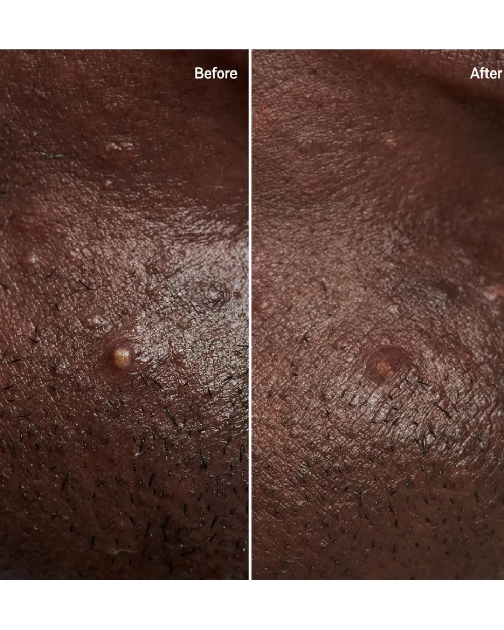 the inkey list pimple patch Hydrocolloïde pleisters voor onzichtbare puistjes
