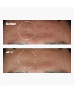 the ordinary serum Niacinamide 10% + Zinc 1%